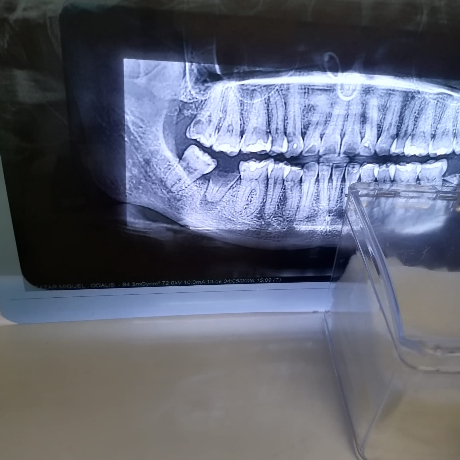 Extracción Dental Caso B