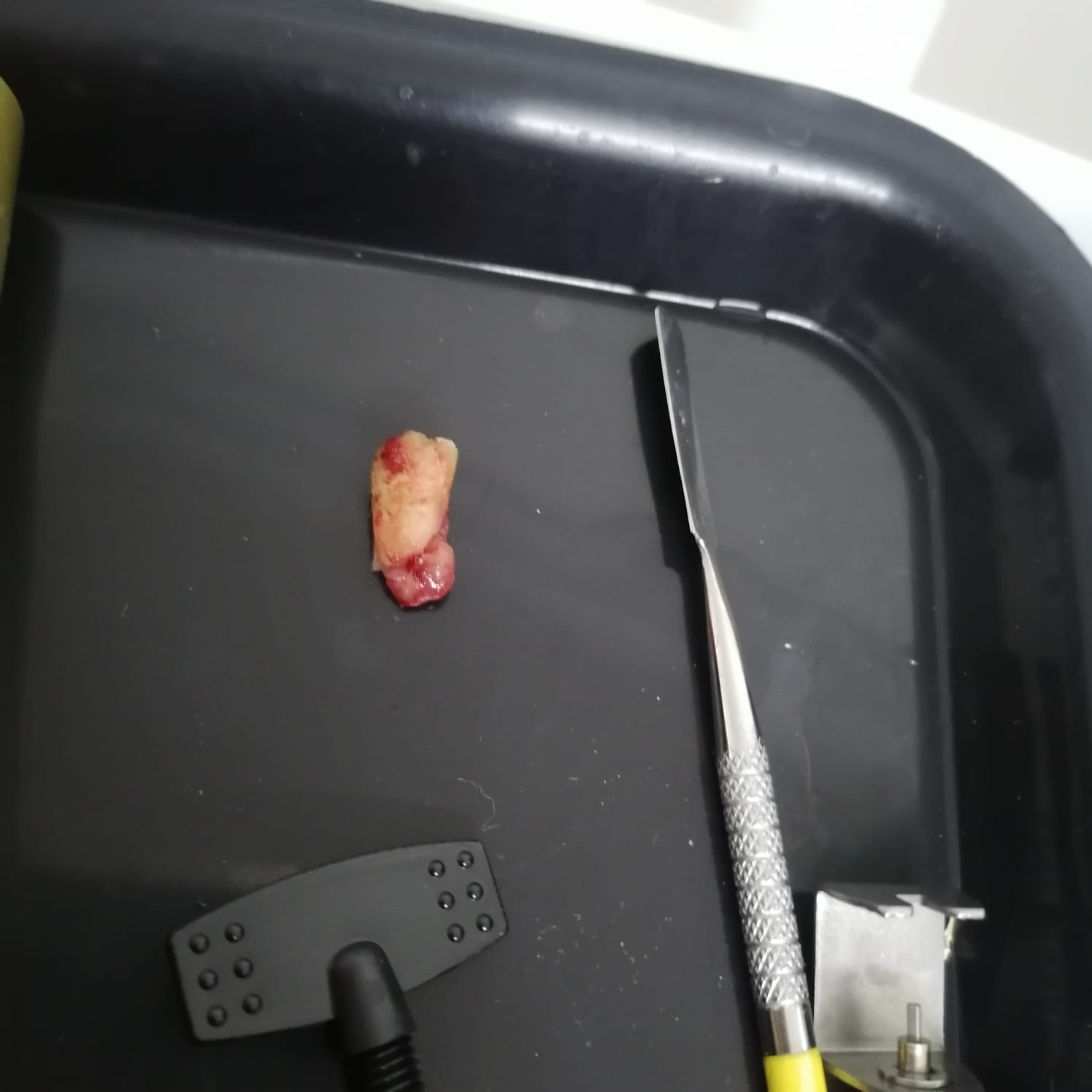 Extracción Dental Caso A