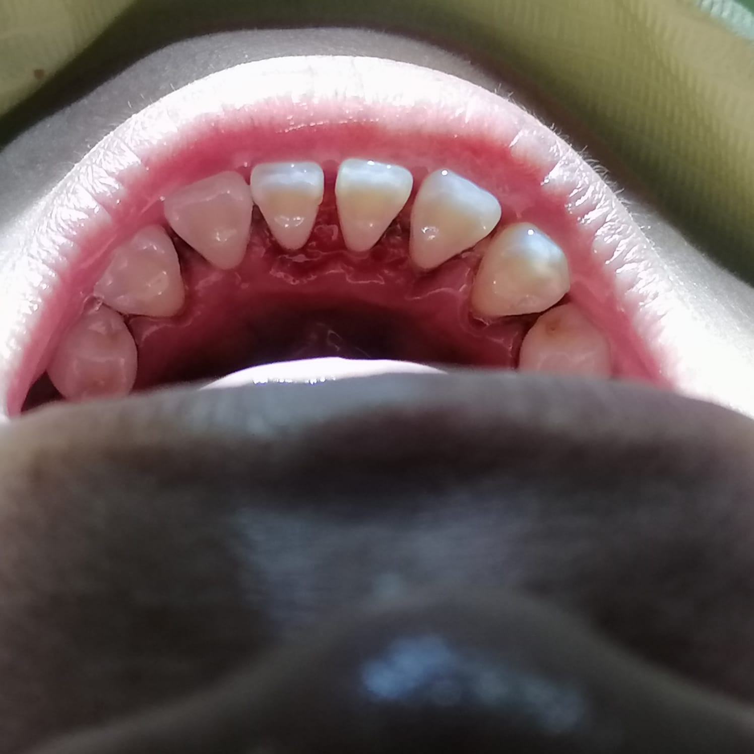 Limpieza Dental Caso A