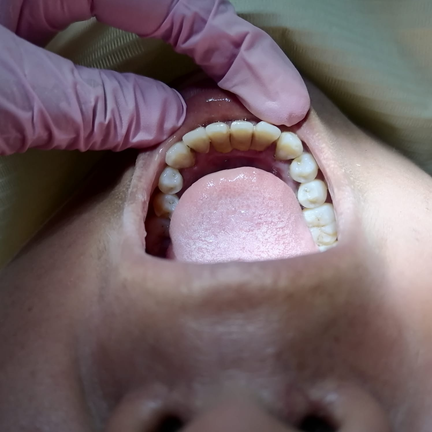Limpieza Dental Caso B