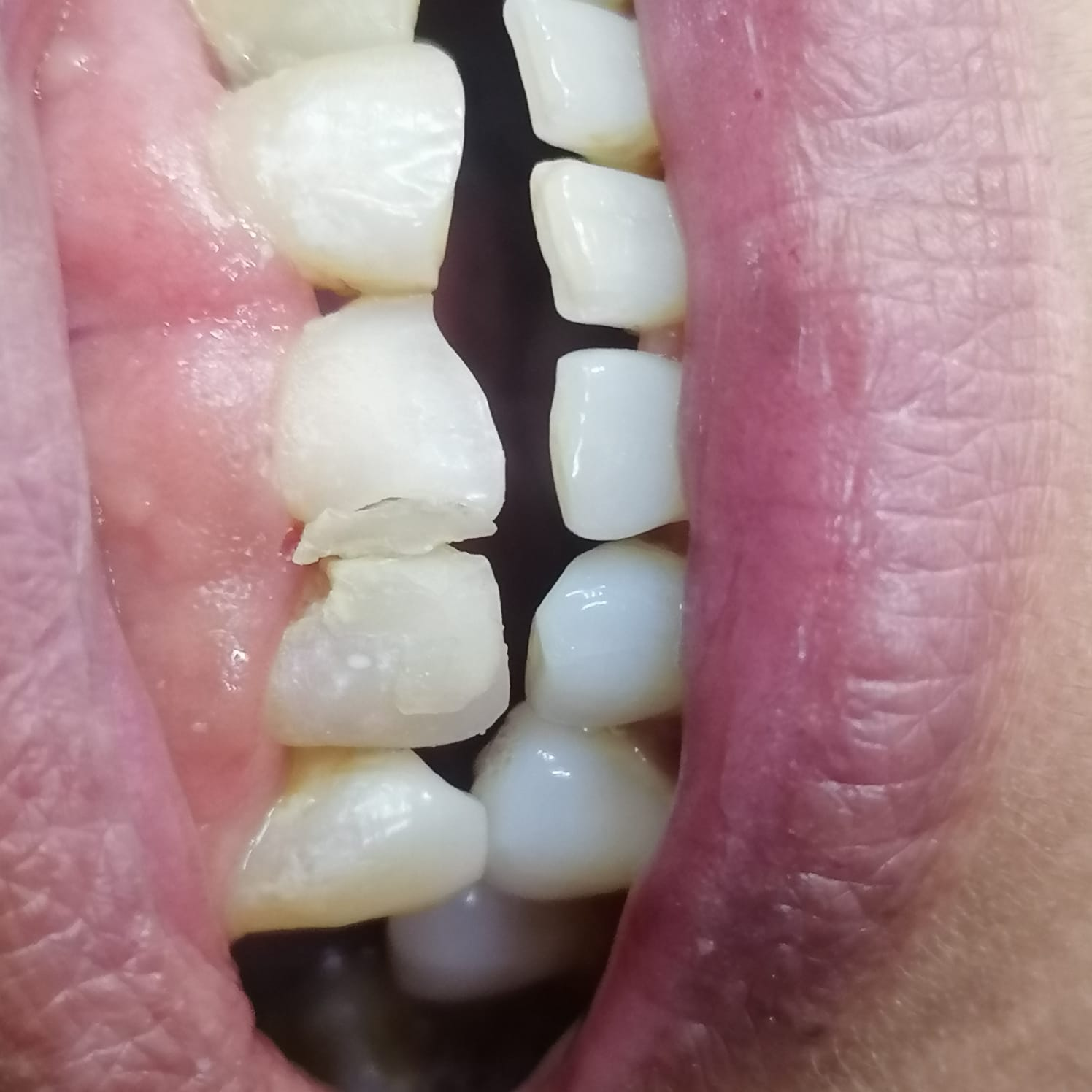 Resina Estética Caso B